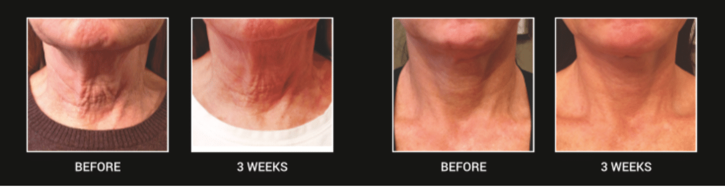 Series of images showing the before and after using neck firming cream