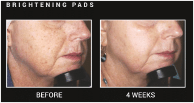 Before and after photos of a woman who used brightening pads
