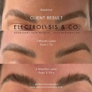 Close-up of curly hair with thinning patches before Pasadena scalp health therapy at Dynasty Dermatology Pasadena, CA