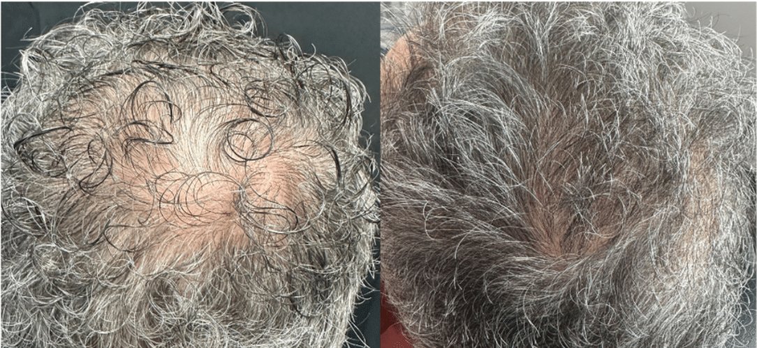 Side view of male scalp with visible hair thinning treated by Pasadena dermatologist at Dynasty Dermatology Pasadena, CA