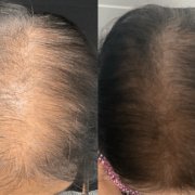 Close-up of male scalp showing thinning hair before Pasadena hair loss treatment at Dynasty Dermatology Pasadena, CA