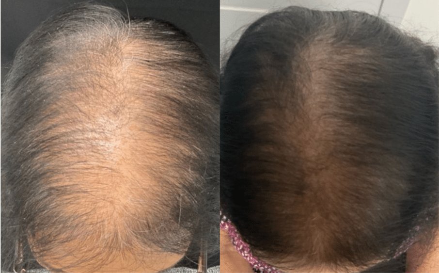 Close-up of male scalp showing thinning hair before Pasadena hair loss treatment at Dynasty Dermatology Pasadena, CA
