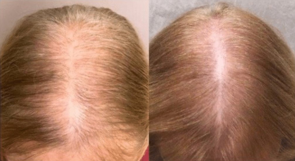 Side-by-side images showing a woman’s thinning hair before and fuller, denser hair after treatment.