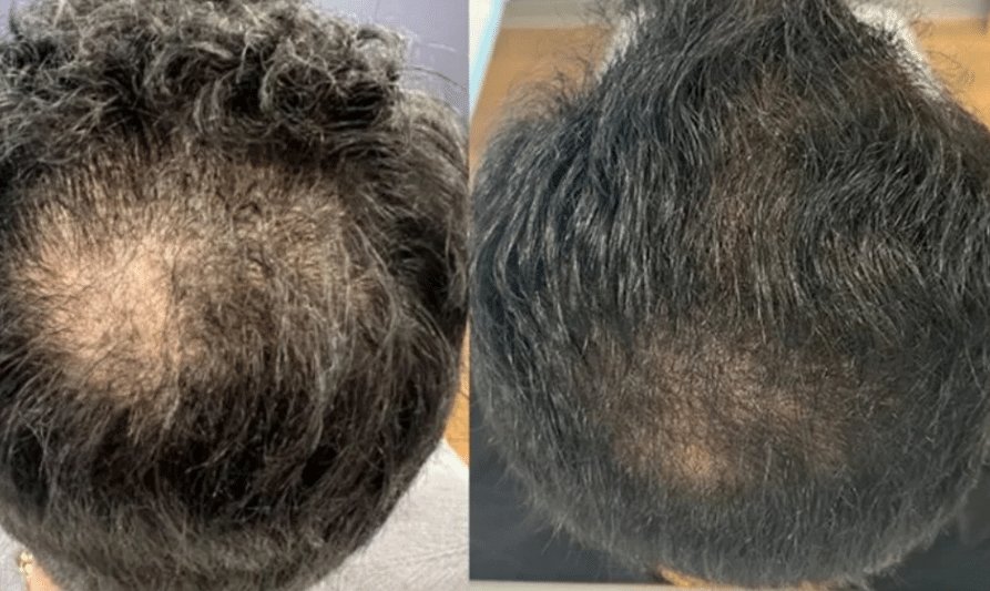 Before and after images of a man’s scalp showing thicker hair and improved hairline.