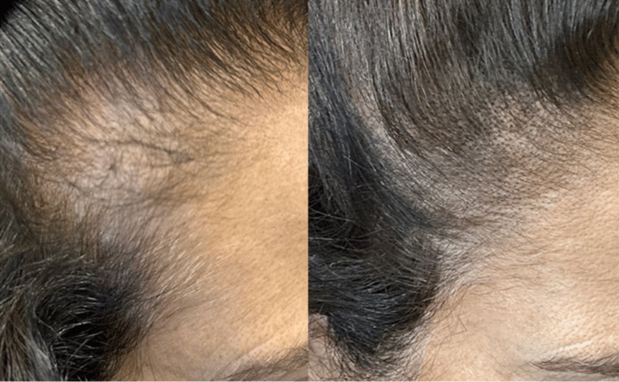 Before and after close-up images of the top of the head showing new hair growth and increased density.