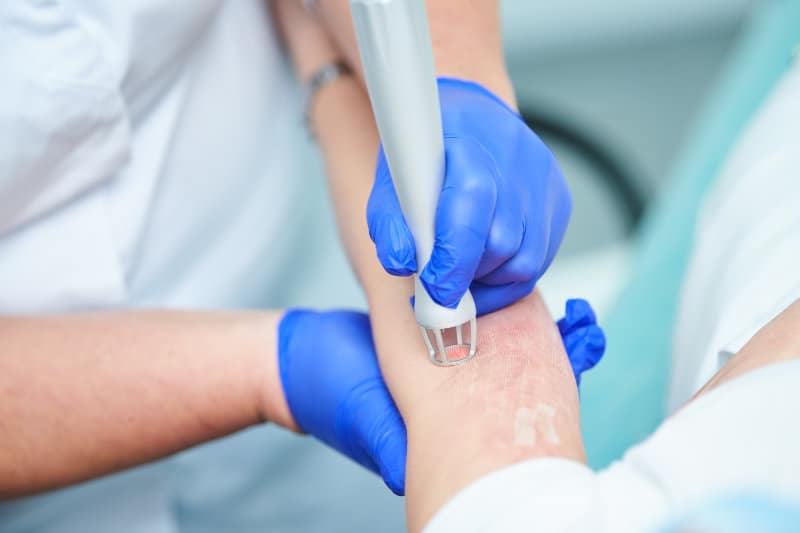 Patient undergoing treatment to remove scars