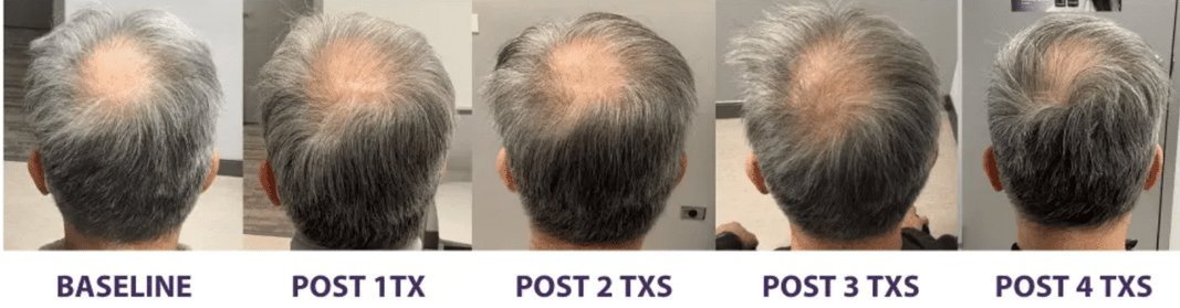 Eyebrow close-up showing electrolysis before and after at Pasadena dermatology clinic Dynasty Dermatology Pasadena, CA