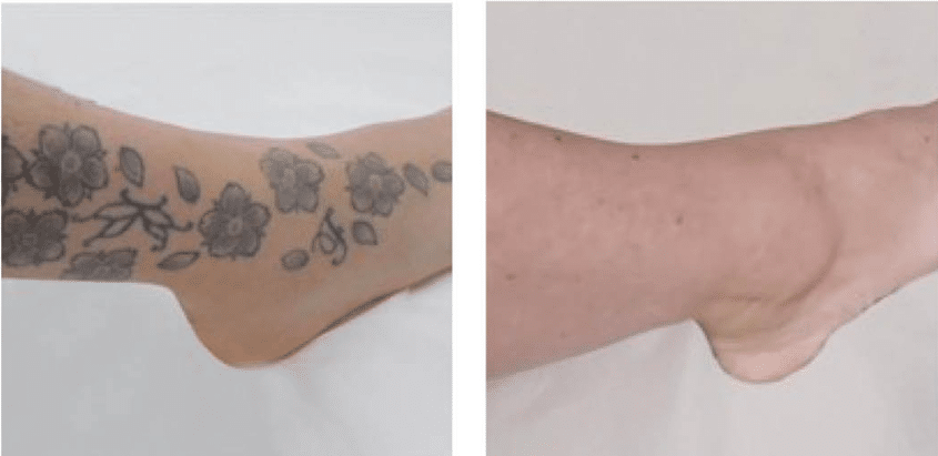 Forearm with visible tattoo before Pasadena laser tattoo removal at Dynasty Dermatology Pasadena, 800 Fairmount Ave, Pasadena, CA.