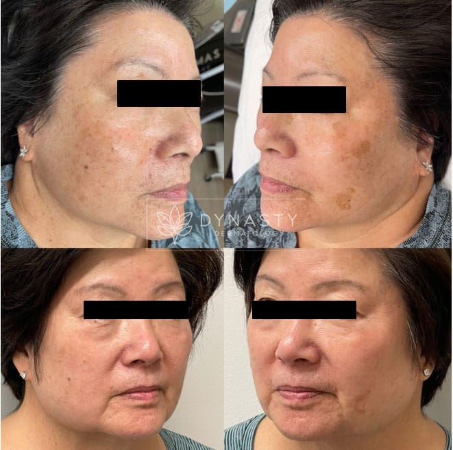 Before and after photos of patient who received Lumecca treatment in Pasadena, CA