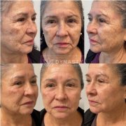 After photos of a patient who received Lumecca sessions in Pasadena, CA