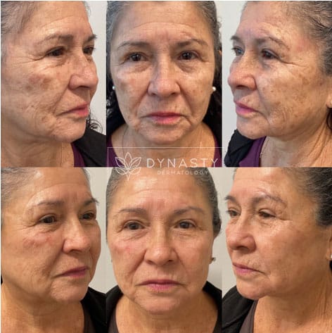 After photos of a patient who received Lumecca sessions in Pasadena, CA