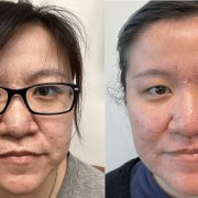 Before and after photos of an asian woman who received Hollywood Spectra Laser treatment for acne scars