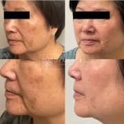 Results of Lumecca treatment on Asian