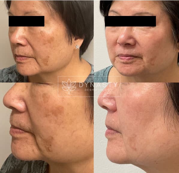 Results of Lumecca treatment on Asian