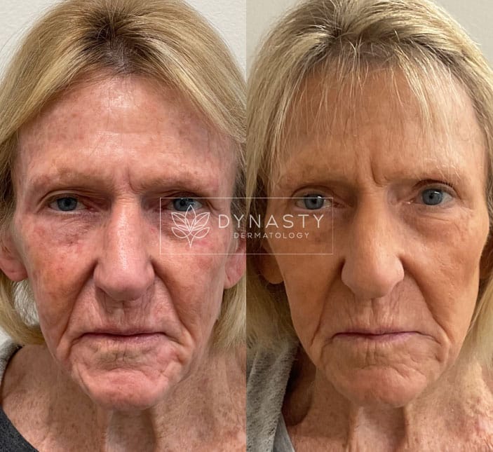Patient transformation, showing the before and after of Blepharoplasty and UltraClear