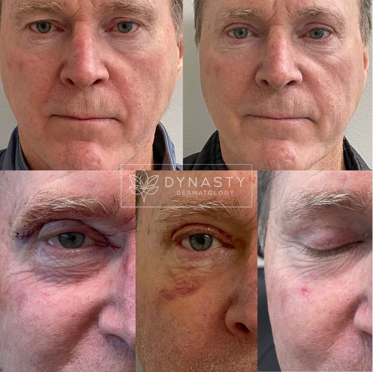 Patient transformation, showing the before and after of Blepharoplasty
