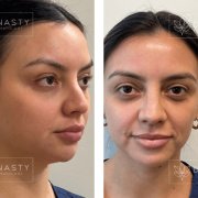 Before and after photos showing Voluma and Juvederm treatment results