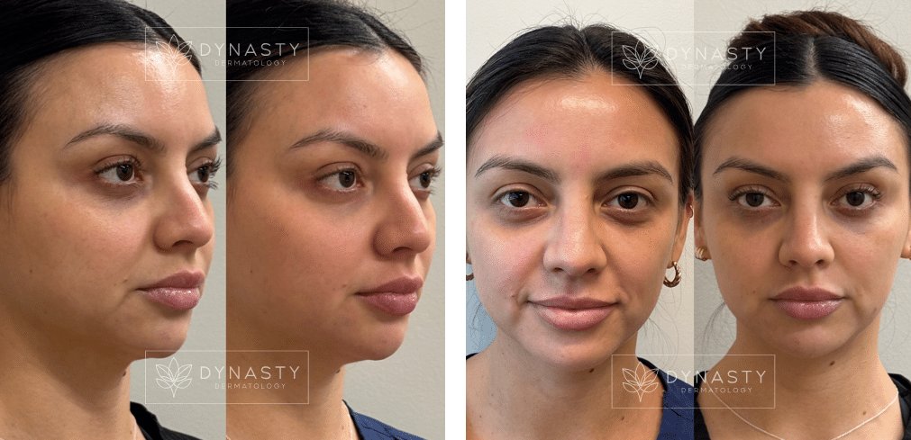 Before and after photos showing Voluma and Juvederm treatment results