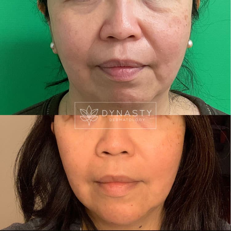 Patient transformation showing before and after Voluma and Volux