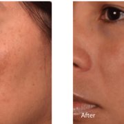 Before and after photos of an asian woman who received Hollywood Spectra Laser treatment