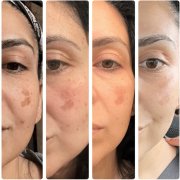 Before and after photos of a woman who received Hollywood Spectra Laser treatment for Melasma