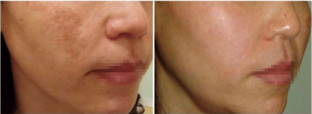 Before and after photos of a patient that received Hollywood Spectra Laser treatment