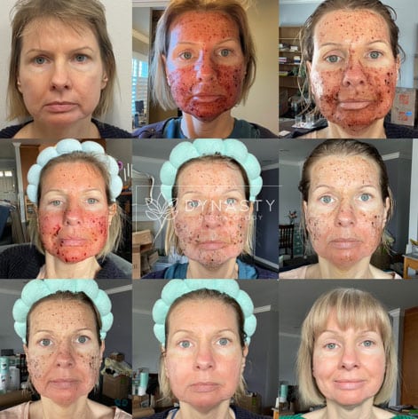 Before and after photos of a female patient who received UltraClear Deep Laser (Coring) treatment for acne scars