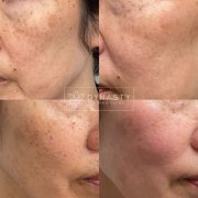 Before and after treatment of Lumecca treatment on asian skin