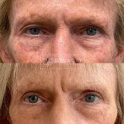 Patient who received an Upper Eyelid Blepharoplasty in Pasadena, CA