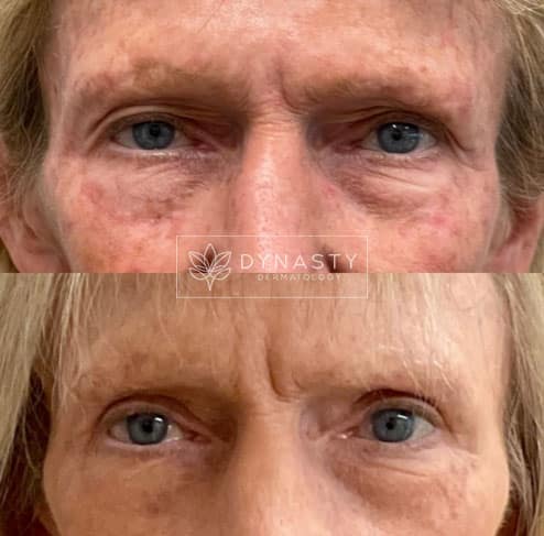 Patient who received an Upper Eyelid Blepharoplasty in Pasadena, CA