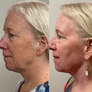Before and after photos of a female patient who received UltraClear Deep Laser (Coring) treatment around the neck