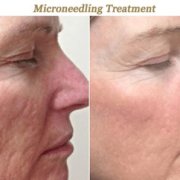 Woman that received microneedling for texture scars in Pasadena CA showing her transformation