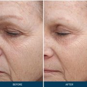 Before and after photos of a patient that received PRP and Microneedling in Pasadena CA
