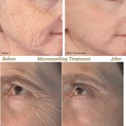 Before and after photos of a patient that received PRP and Microneedling in Pasadena CA