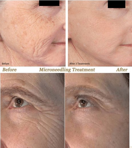 Before and after photos of a patient that received PRP and Microneedling in Pasadena CA