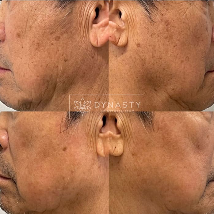 Results after 1 session of Lumecca treatment on a patient