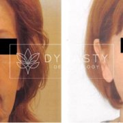 Before and after photos of a woman that received sculptra treatment in Pasadena CA