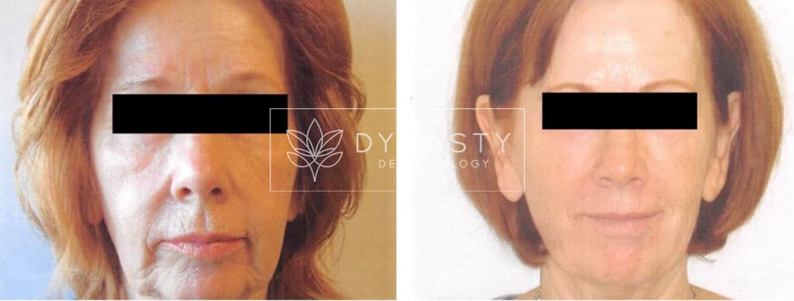 Before and after photos of a woman that received sculptra treatment in Pasadena CA