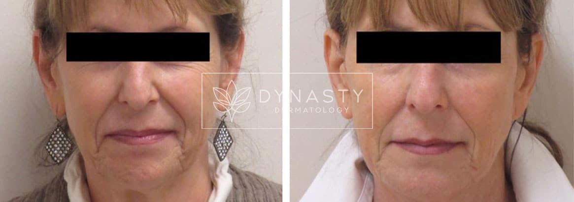 Before and after photos of a woman that received sculptra treatment in Pasadena CA