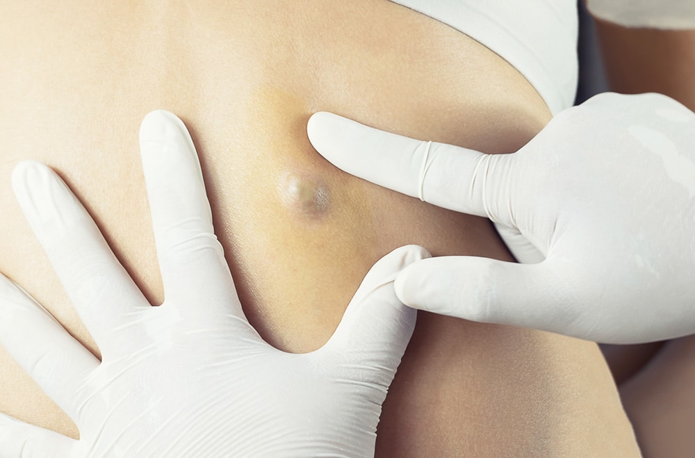 Dermatologist examining a cyst on a patient for a cyst removal 