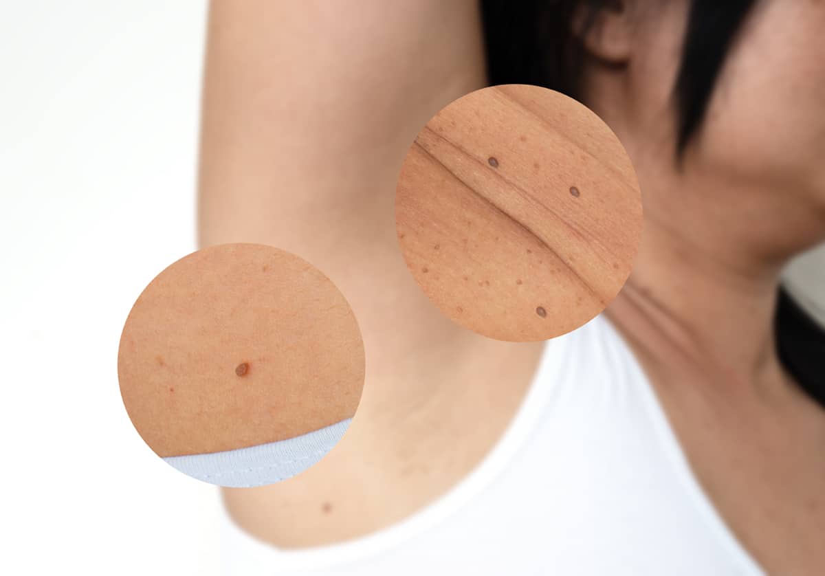 Image of a woman showing the skin tags on her arm