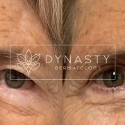 Close up of a patient who received an Upper Eyelid Blepharoplasty in Pasadena, CA