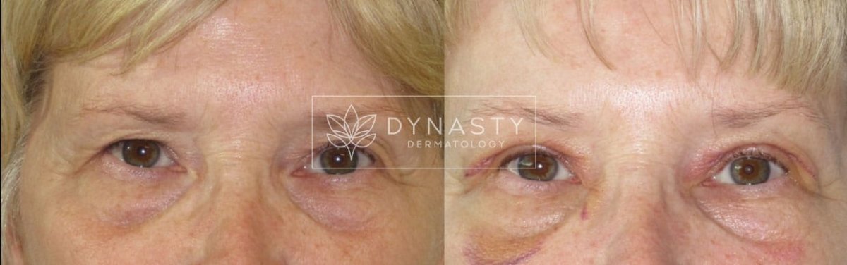 Patient transformation, showing the before and after of Upper Blepharoplasty