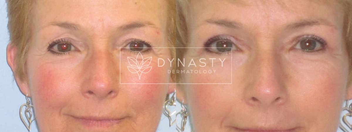 Patient transformation, showing the before and after of Upper Blepharoplasty