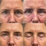 Before and after photos of a patient that received Lumecca treatment on the upper eyelid