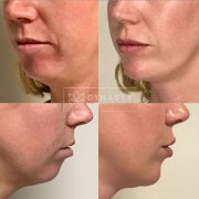 Patient transformation showing before and after Voluma for cheekbones