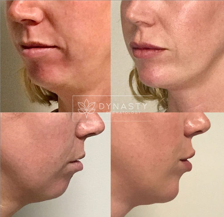 Patient transformation showing before and after Voluma for cheekbones