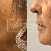 Patient transformation showing before and after Voluma for upper face lifting