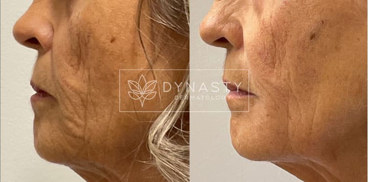 Patient transformation showing before and after Voluma for upper face lifting