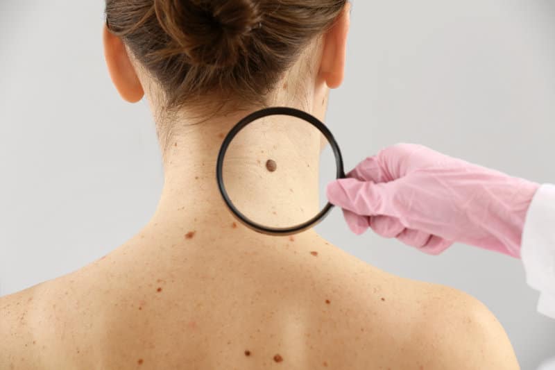 Doctor examining a mole on a female patient's neck